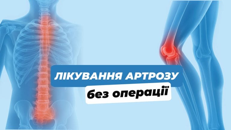 likuvannya artrozu mini